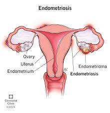 Endometriose